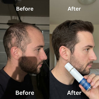 🎉BUY 1 GET 1 FREE🎉Hair Growth Roll on Serum